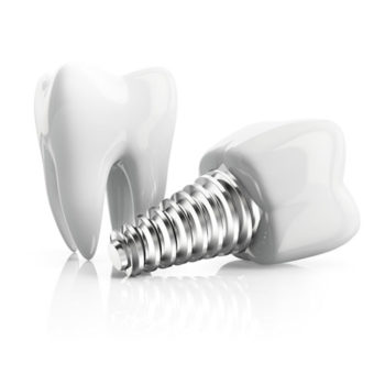 dental implants on white background