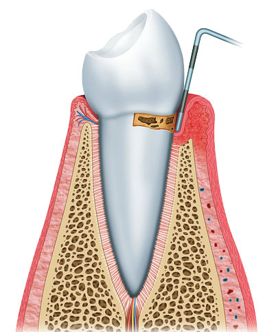 the start of periodontal diease