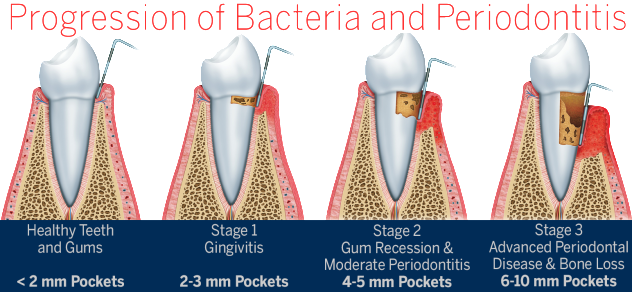 periodontal-surgery