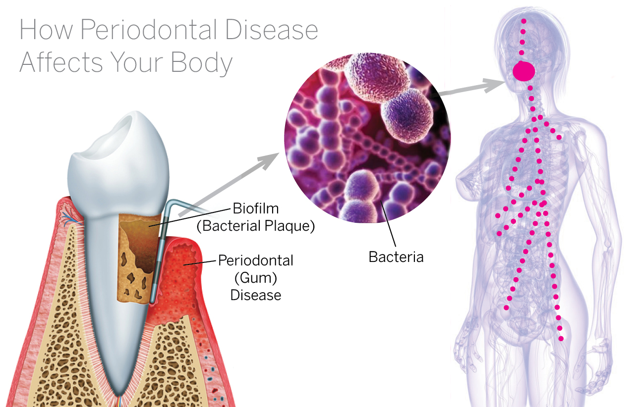 Systemic Complications - Pristine Periodontics and Implants