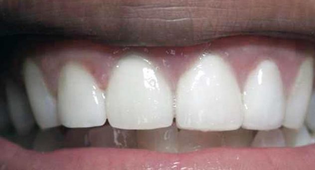 Dental Implant with Bridge After