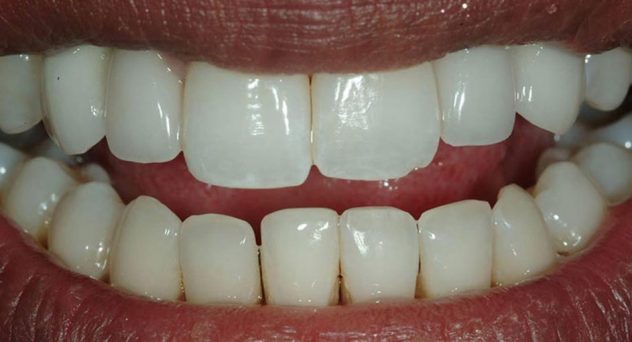 Gum disease and implant treatment - after