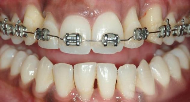 Gum disease and implant treatment - Before
