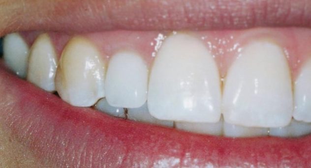Single Tooth Replacement After