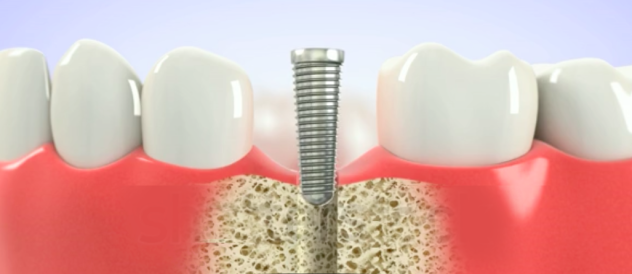 dental implant process first step