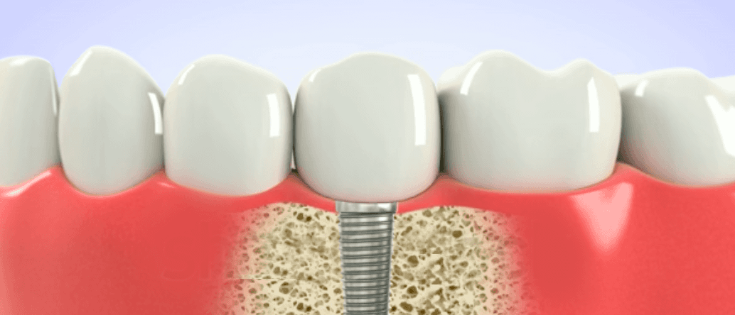 dental implant crown placement