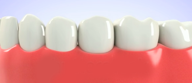 dental implant final step