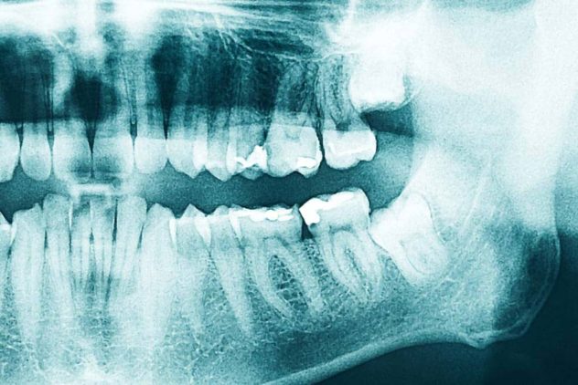 periodontal disease xray