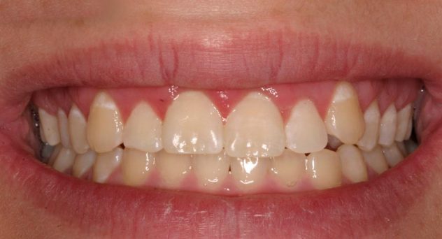 After crown lengthening 4