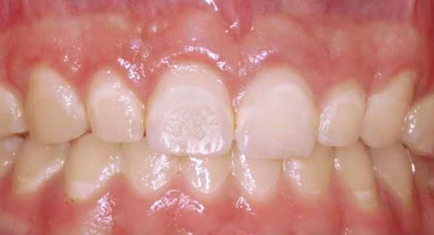 After crown lengthening 5