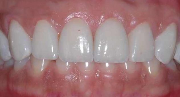 After Crown Lengthening