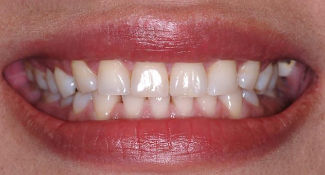 before crown lengthening 3