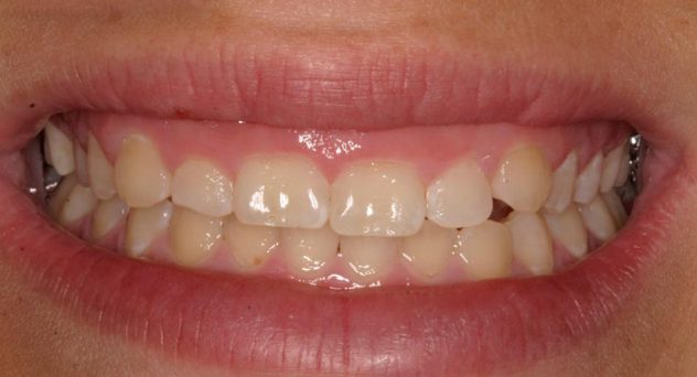 Before crown lengthening 4