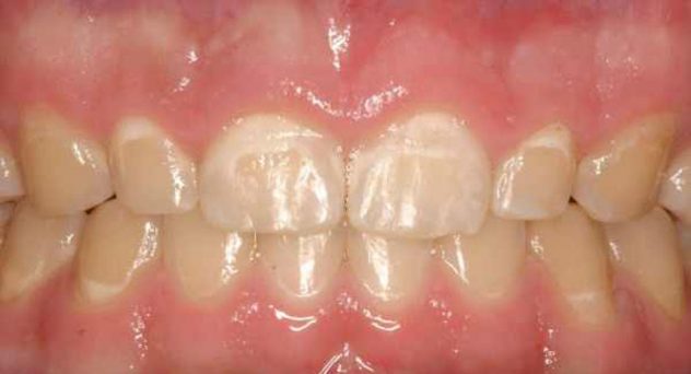 before crown lengthening 5