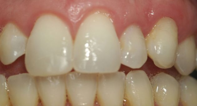 Gum Recession Treatment After