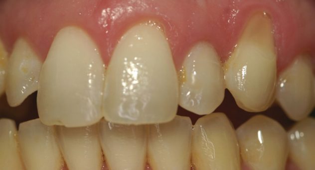 Gum Recession Treatment Before