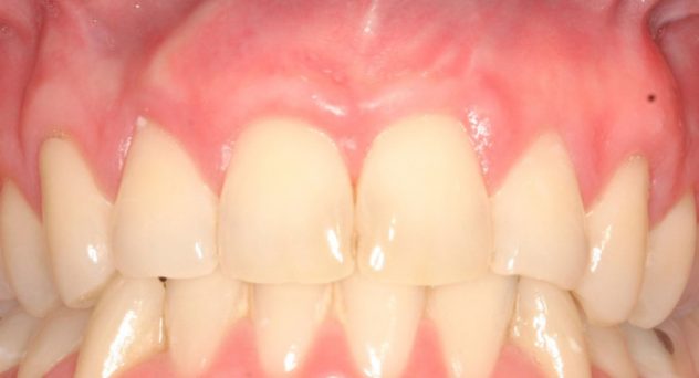Gum Recession Treatment After