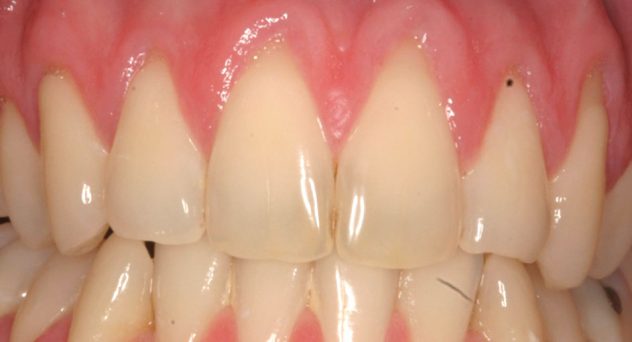 Gum Recession Treatment Before