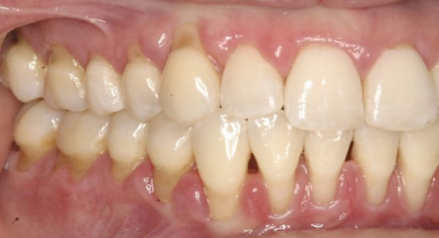Gum Recession Treatment Before