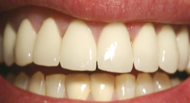 Gum Recession Treatment After