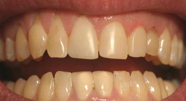 Gum Recession Treatment Before