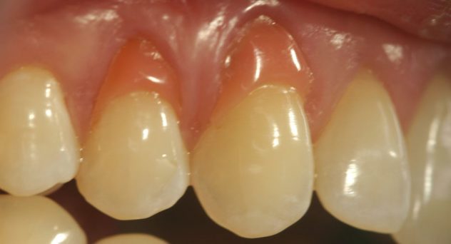 Gum Recession Treatment before