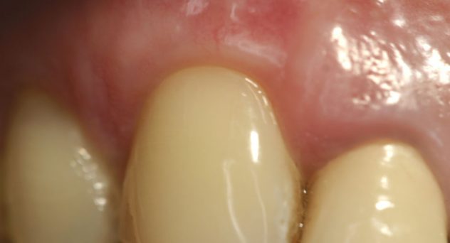 Gum Recession Treatment After