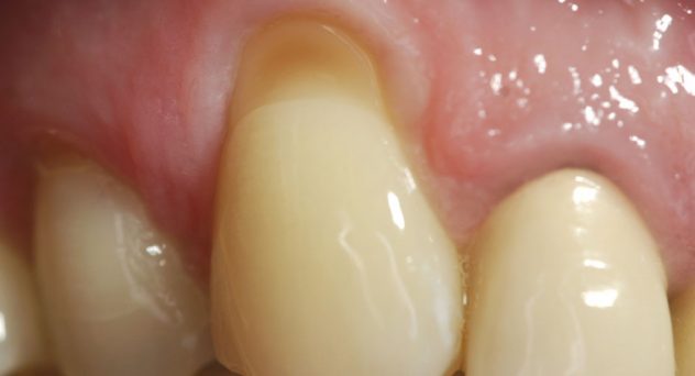 Gum Recession Treatment Before