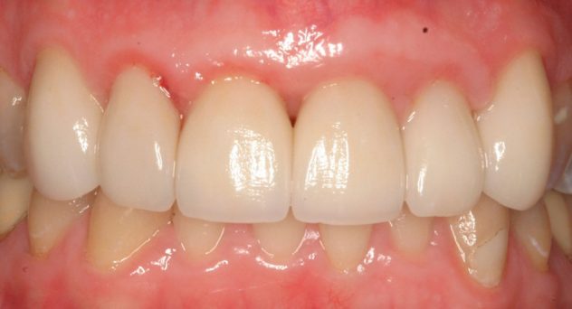 Gum Recession Treatment After