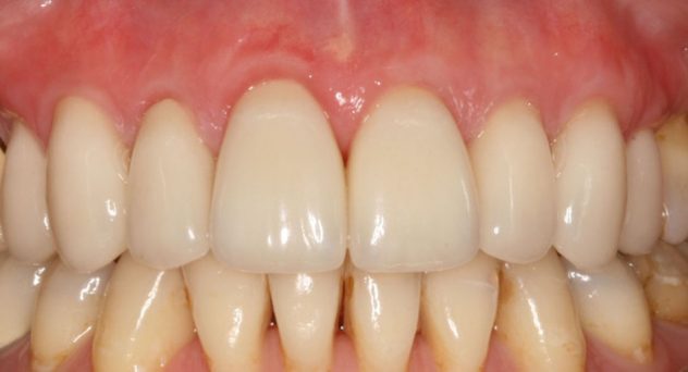 Gum Recession Treatment After