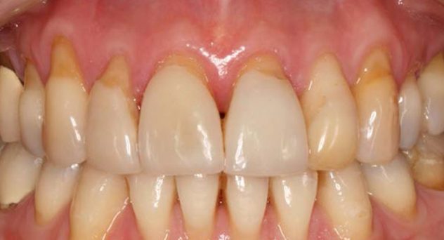 Gum Recession Treatment Before