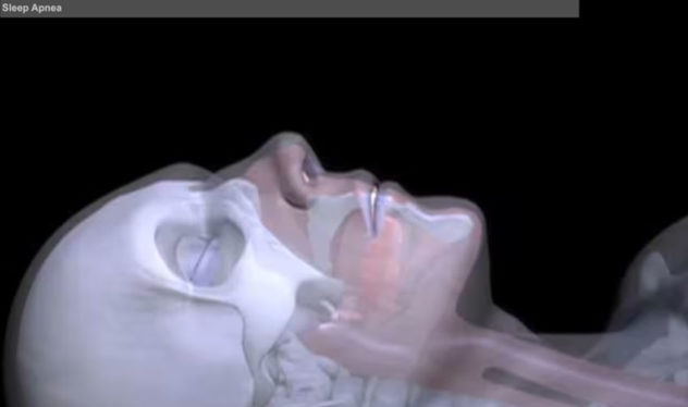 sleep apnea video
